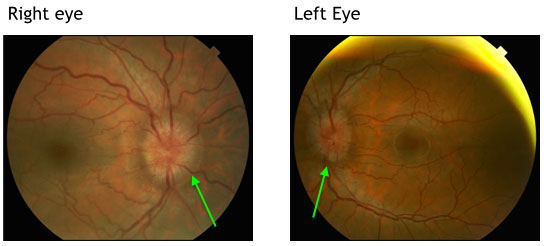 Photo of eyes affected by Papilledema
