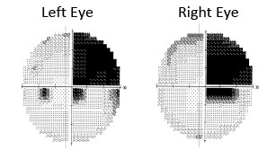 Visual Field Test results from a patient with a stroke