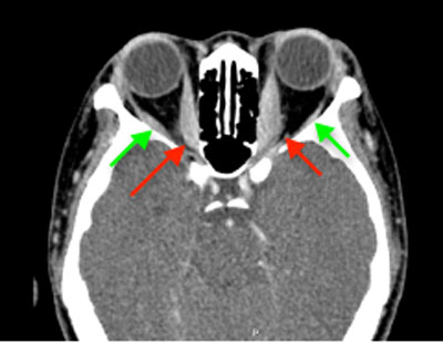 CT scan of a patient with thyroid eye disease