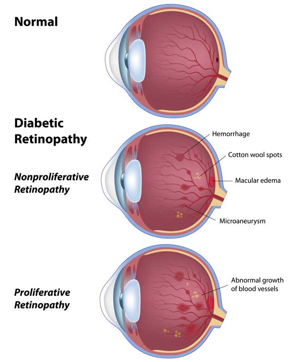 Chart showing a healthy eye compared to one with diabetic retinopathy