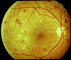 Fundus photo of normal macula
