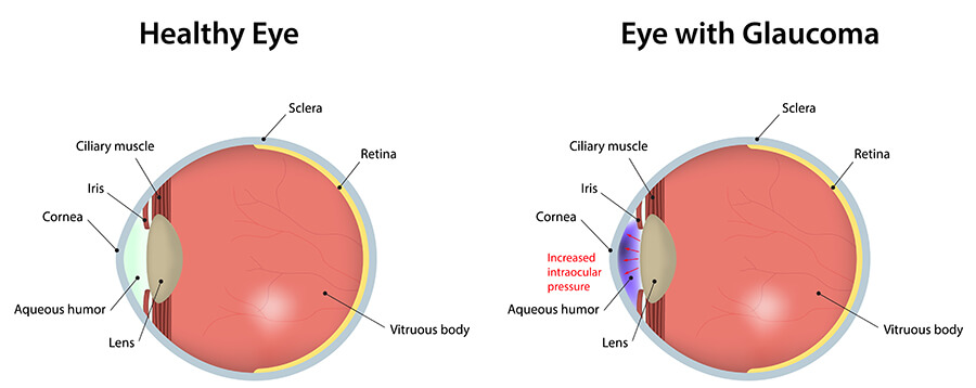 Chart showing a healthy eye compared to one with glaucoma