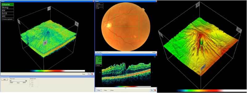 OCT imaging of an eye with an epiretinal membrane taken using a commercial spectral-domain OCT device (3D OCT-2000, Topcon).