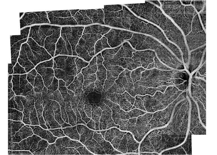 OCT mosaic angiogram of a normal eye taken using prototype software on a commercially-available OCT device (Avanti, Optovue, Inc).