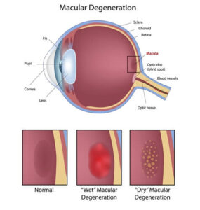 diagram of macular degeneration 