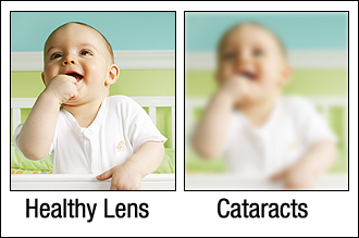 healthy lens example and cloudy lens
