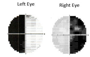 Ophthalmologist Boston | Pituitary Tumor Boston | NEEC