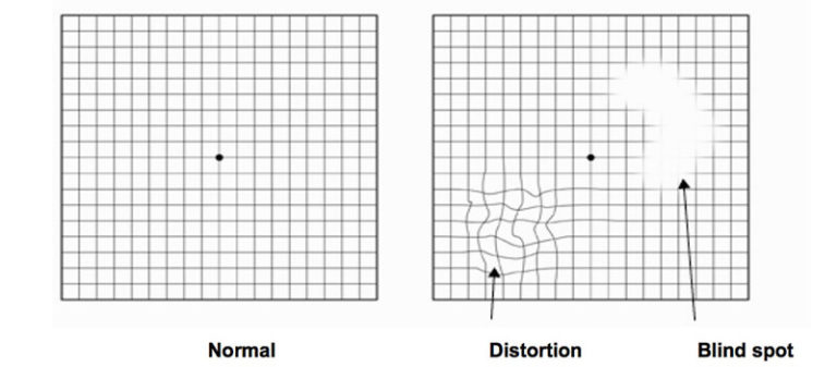 Retina Boston | Macular Degeneration Boston | NEEC